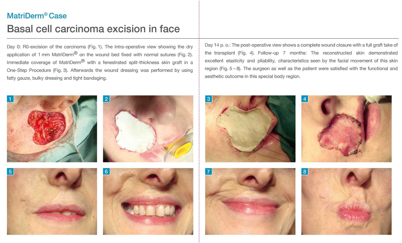 Skin grafting