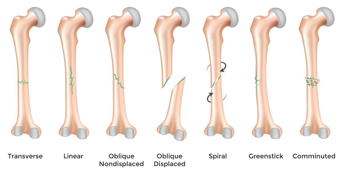 Femoral Shaft Open Fractures
