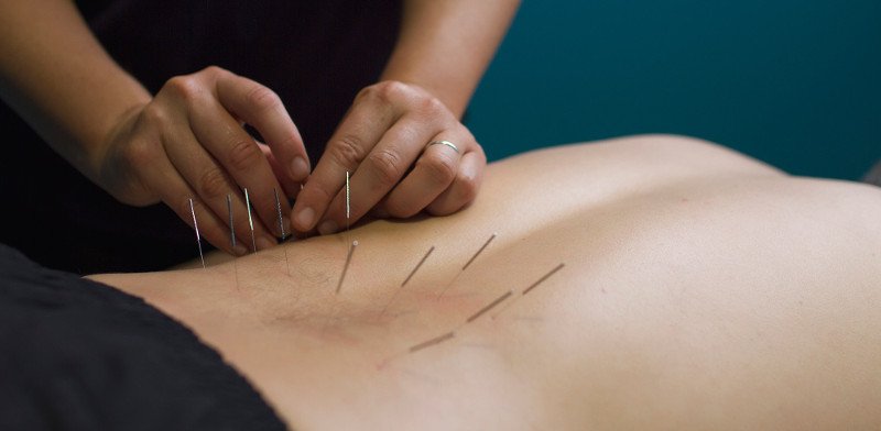 Dry needling Therapy