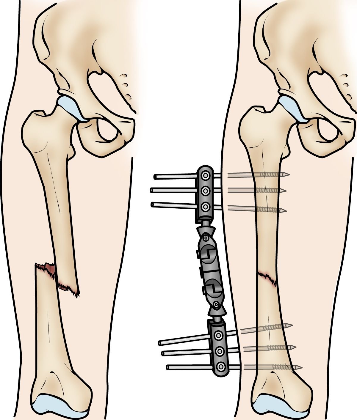 Femoral Shaft Open Fractures