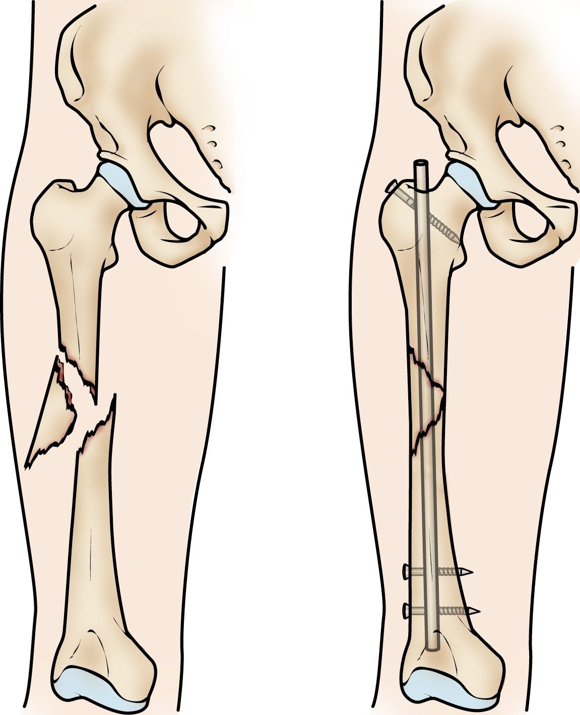 Femoral Shaft Open Fractures