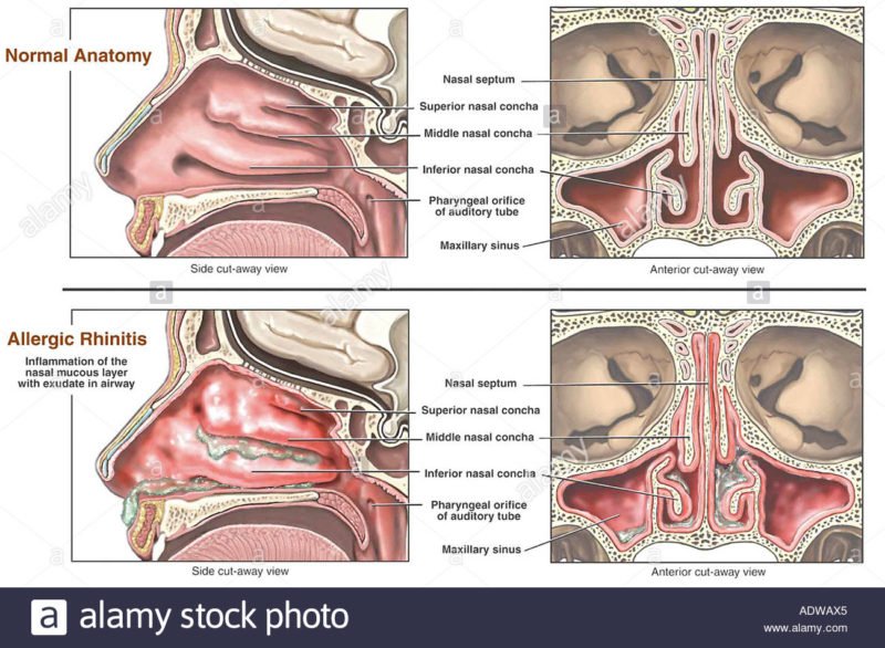 Allergic Rhinitis