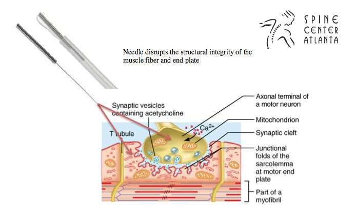 Dry needling Therapy