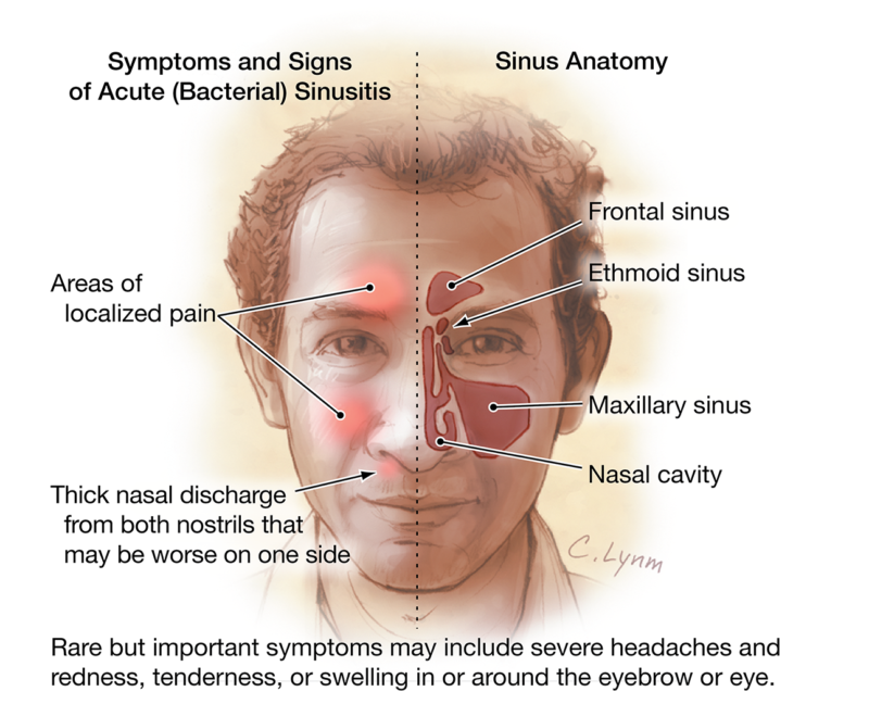 Sinusitis Diagnosis