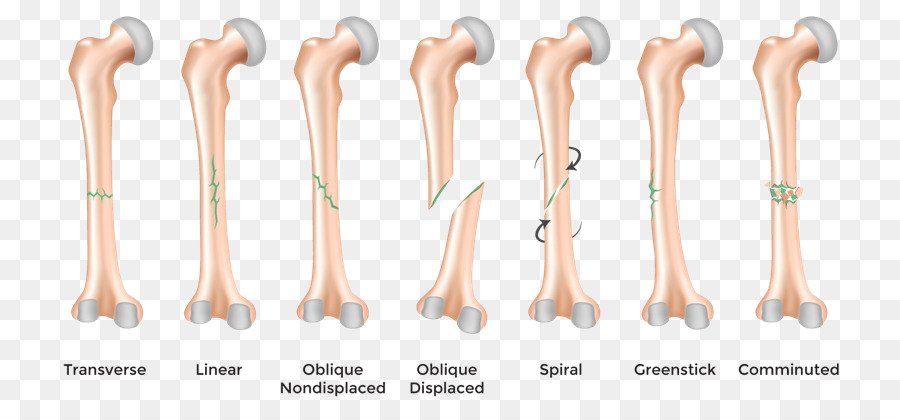 Femoral shaft fractures