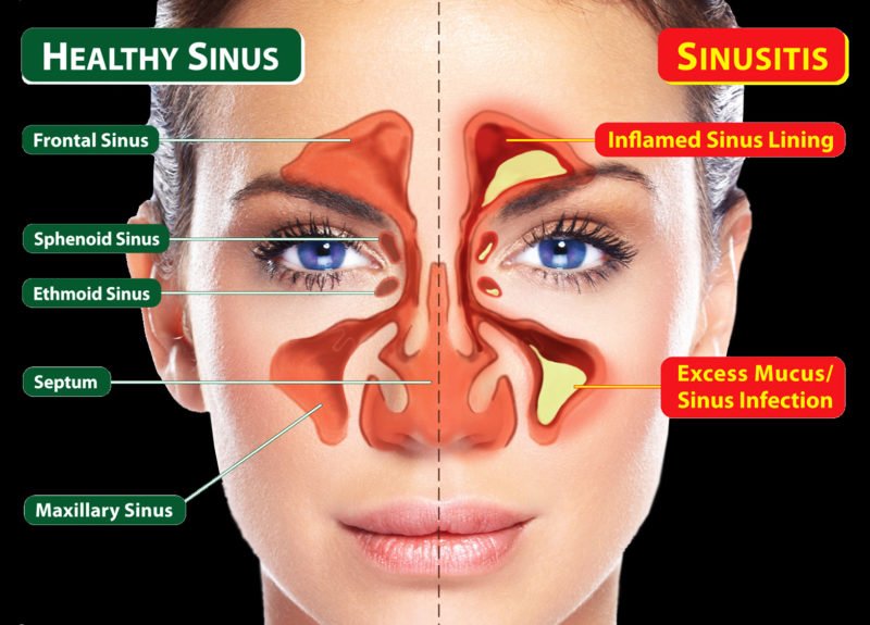 Sinusitis Diagnosis
