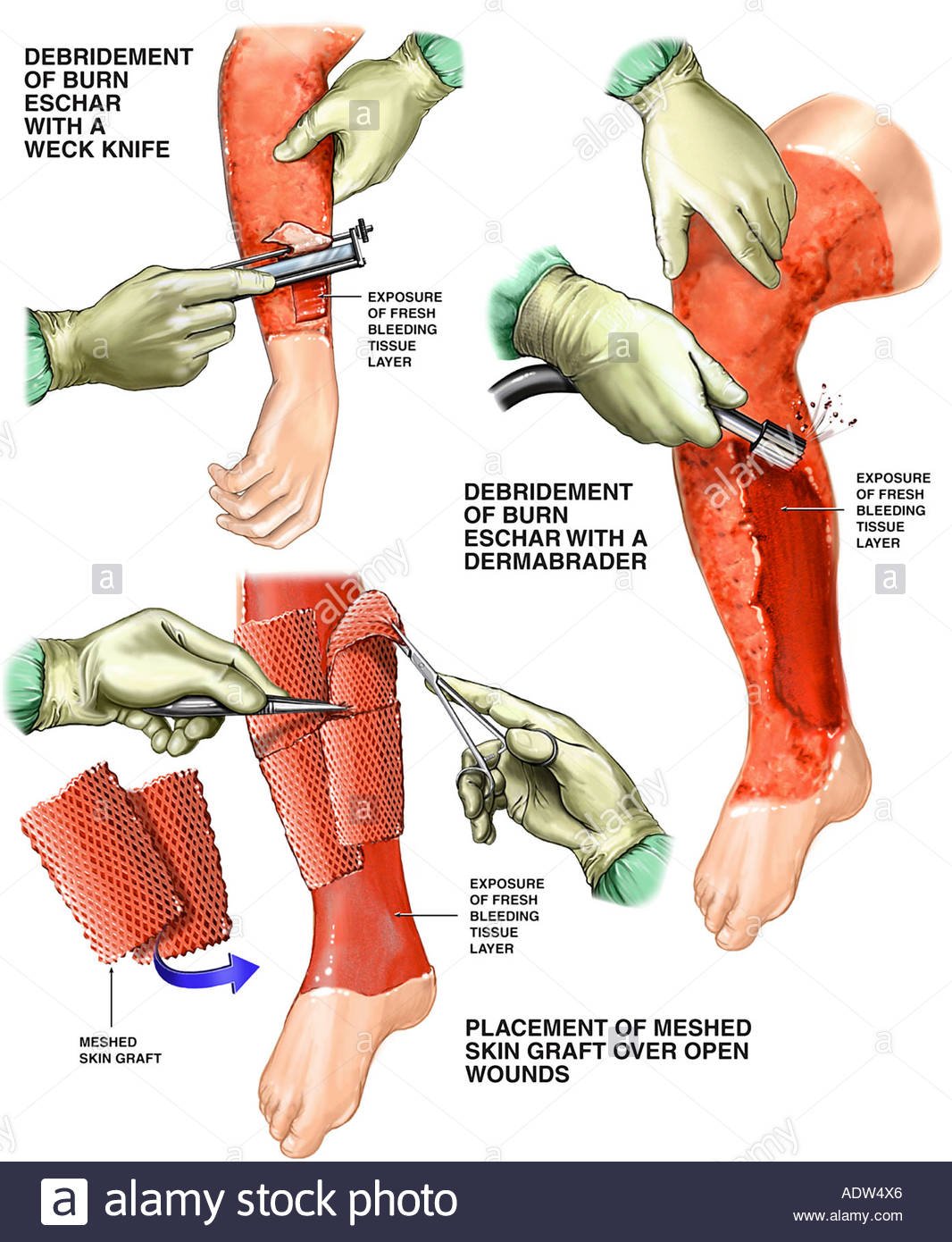 Skin grafting