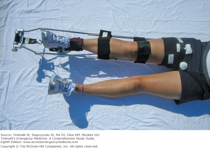 Femoral Shaft Open Fractures