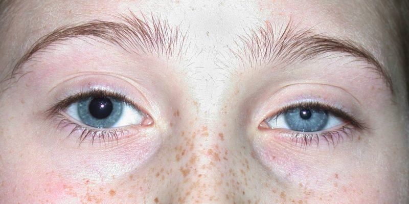 Anisocoria Treatment