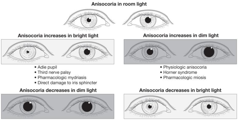 Anisocoria Treatment