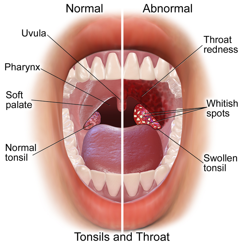 Pharyngitis Diagnosis