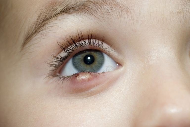 Chalazion Symptoms