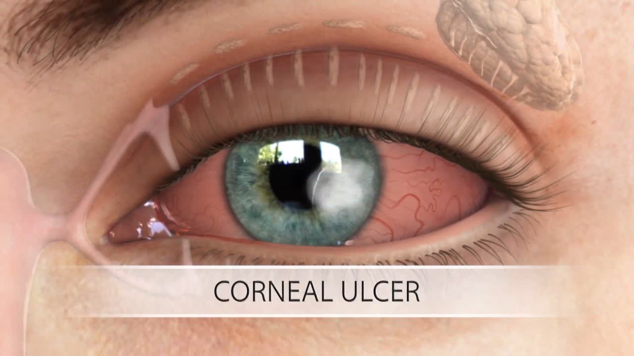Corneal Ulcer Diagnosis