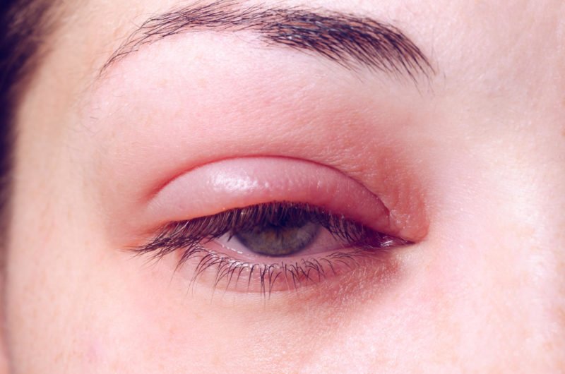 What is The Fastest Way to Heal a Swollen Eyelid