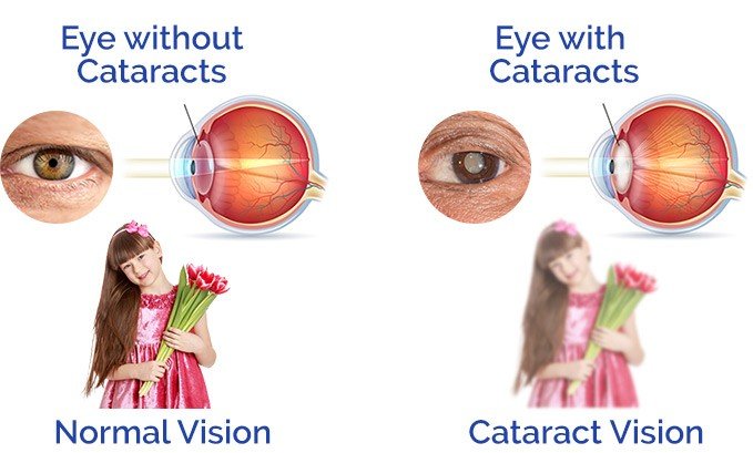 Cataracts