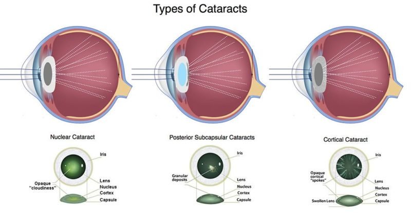 Cataracts