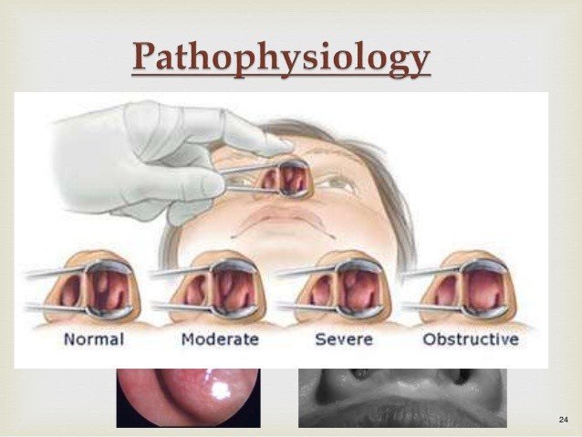 Nasal Polyps Diagnosis