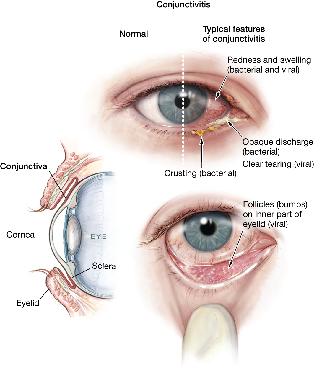 Swollen Eyelids