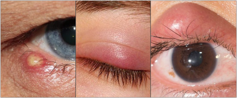 Chalazion Symptoms