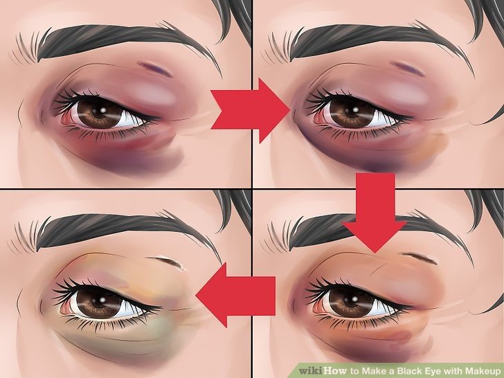 Periorbital Hyperpigmentation Causes