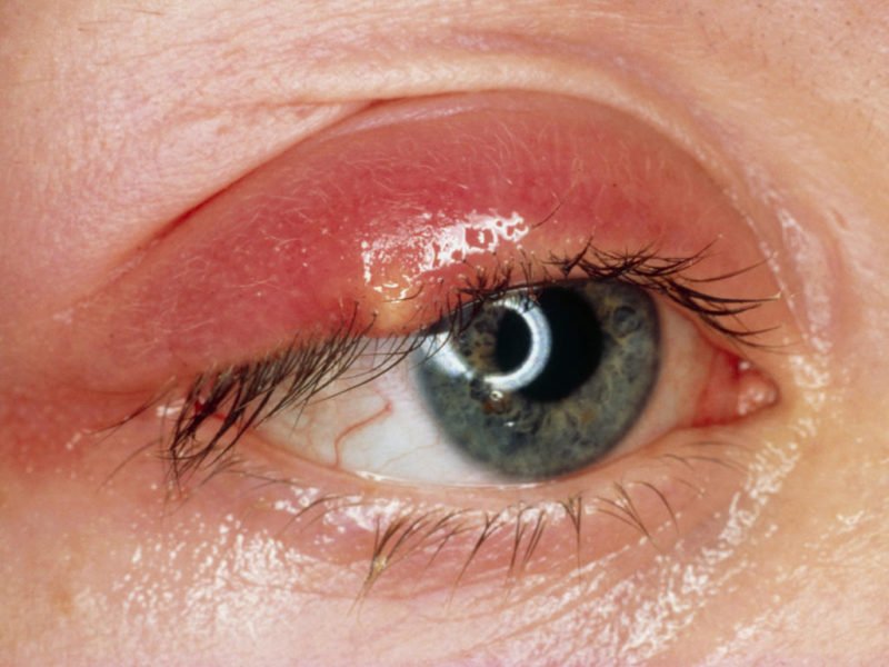 Blepharitis Types