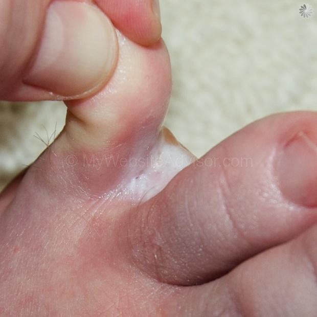 Tinea pedis