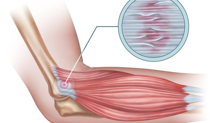 Tennis Elbow Symptoms