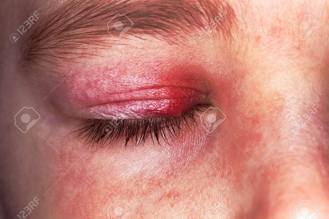 Sjogren’s Syndrome Causes