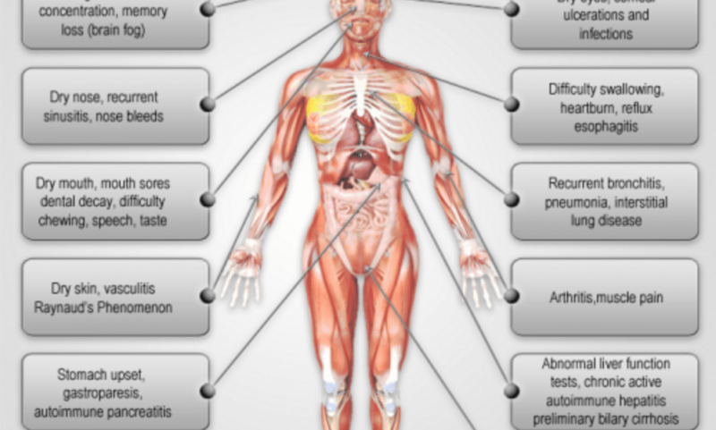 Sjogren’s Syndrome Symptoms
