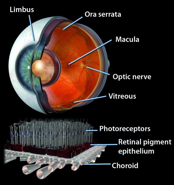 Retinal detachment
