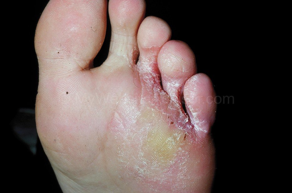 Tinea pedis