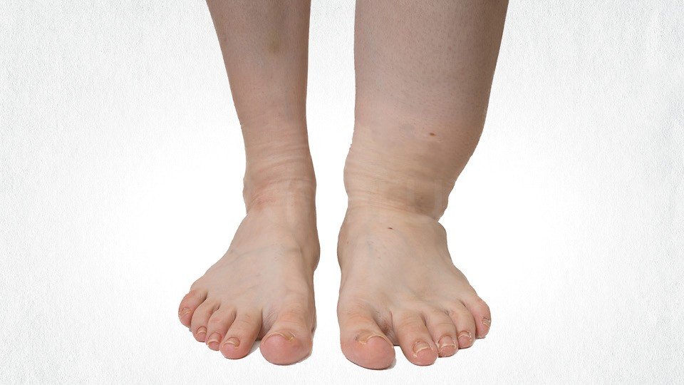 Filariasis