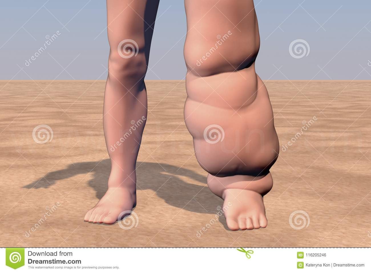 Filariasis Symptoms