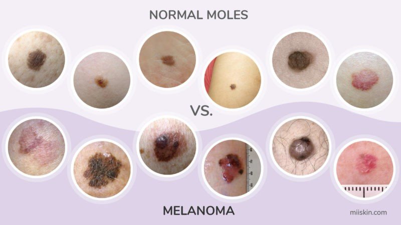 Multiple Mole Melanoma (FAMMM) Syndrome