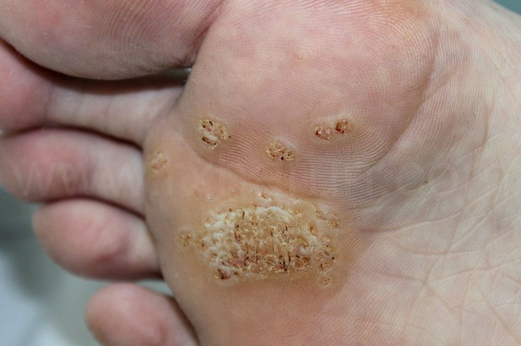 Treatment of Mosaic Warts, Which treatment is Best