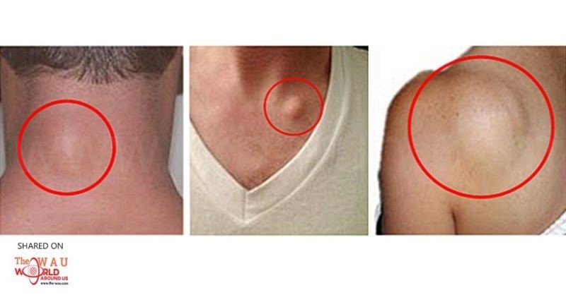 What Are The Main Causes of Lipoma