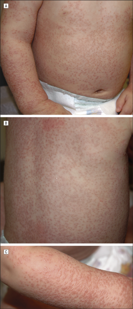 Familial Juvenile Systemic Disease