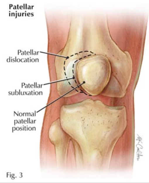 Patellar Dislocation 