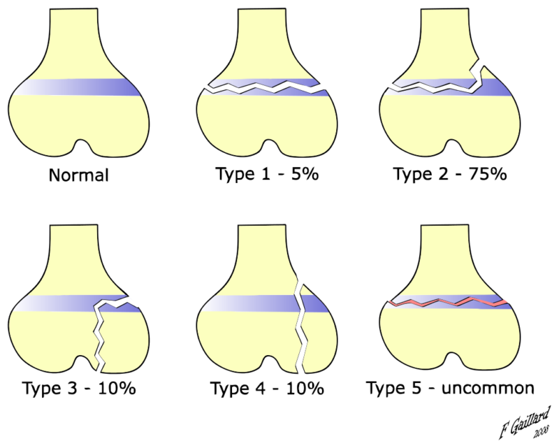 Salter-Harris Type Fractures