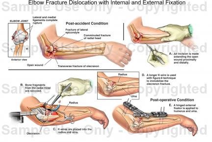 Stiff Elbow (Elbow Contracture)