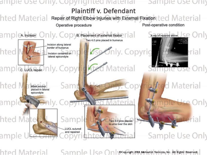 Elbow Joints Injuries