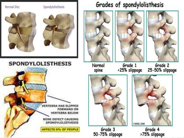 Pars Interarticularis Injury