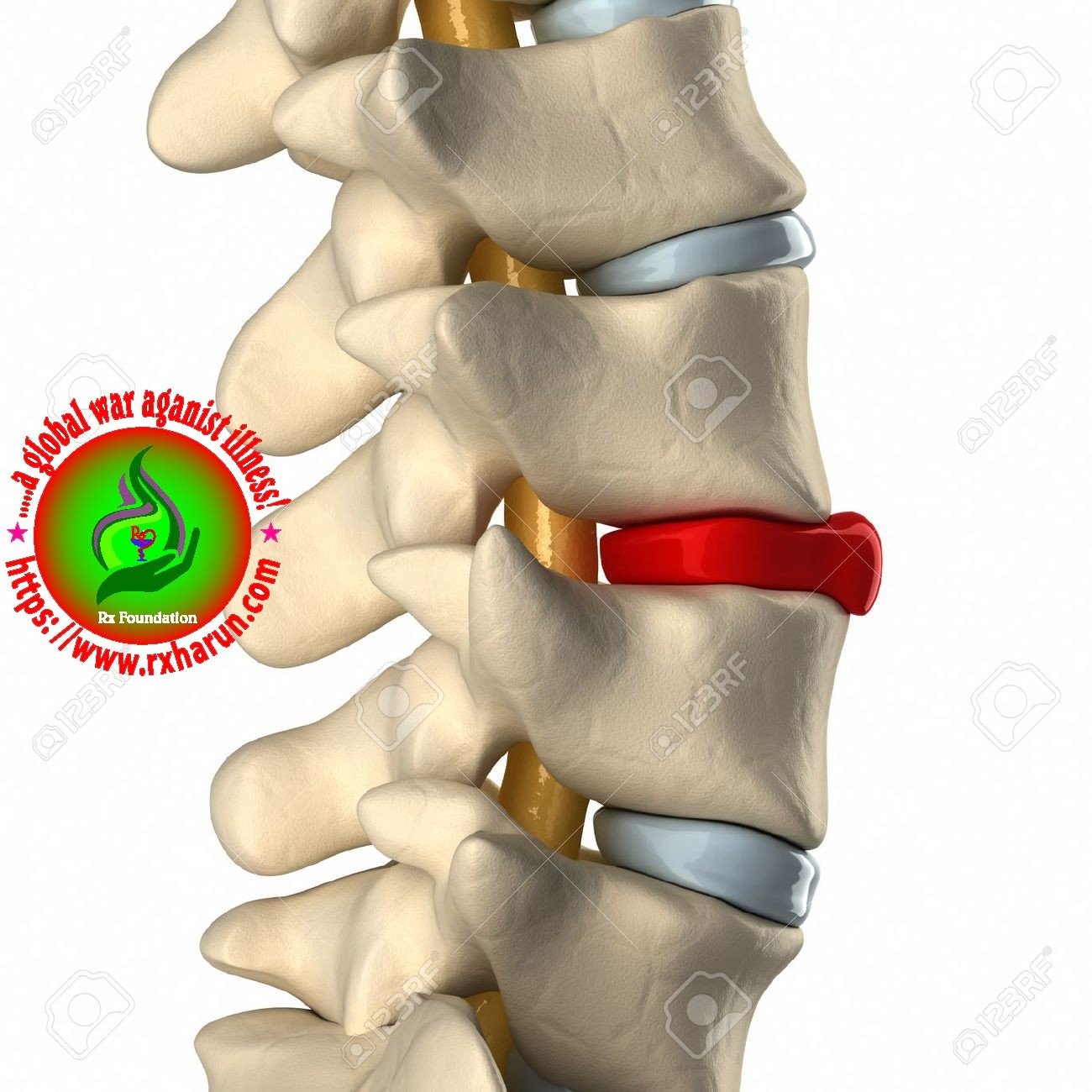 C4 and C5 Disc Herniation