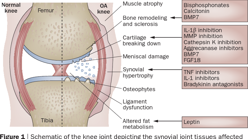 Early Symptoms Of Knee Joints Osteoarthritis