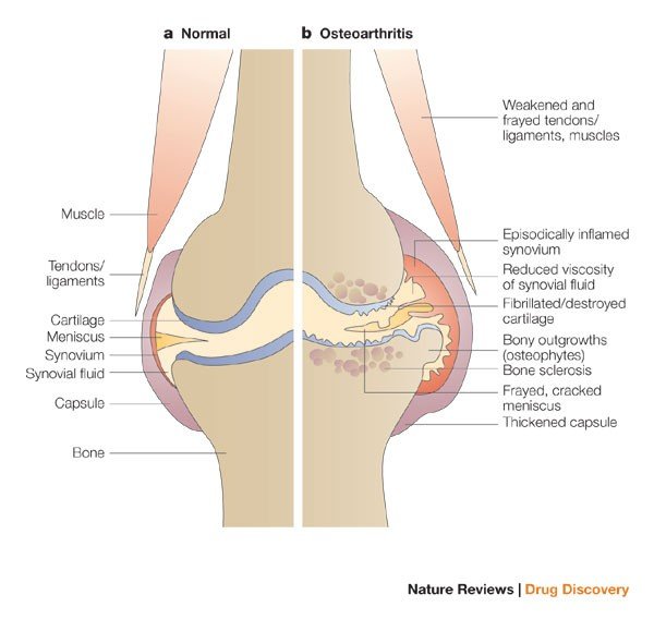 Early Symptoms Of Knee Joints Osteoarthritis