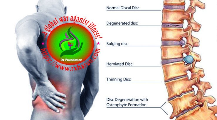 C6 and C7 Disc Herniation