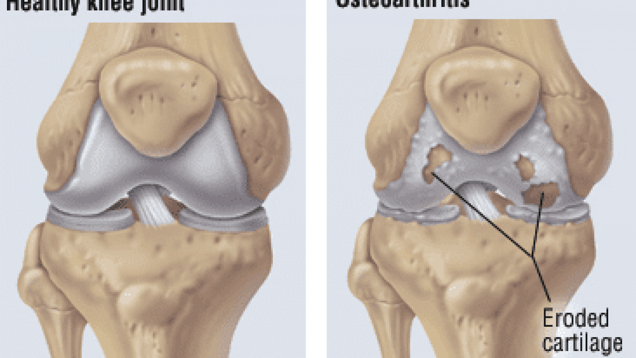 Knee Joints Osteoarthritis