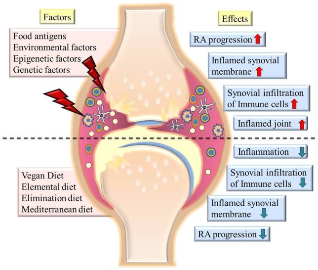Chronic Inflammatory Arthritis