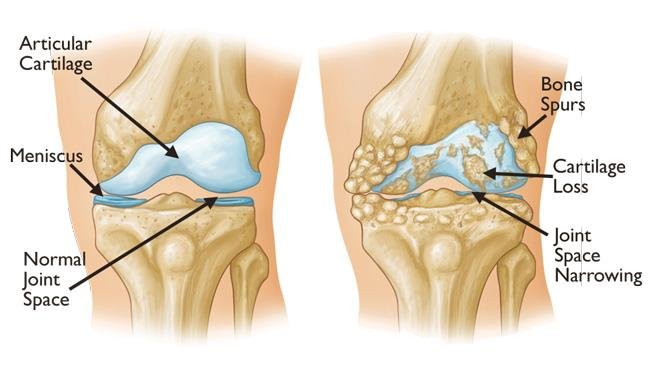 Treatment Of Knee Joints Osteoarthritis