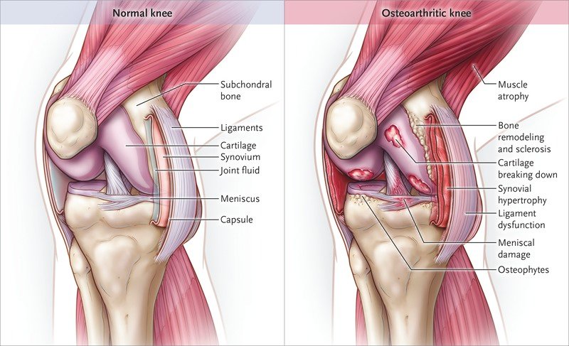 Early Symptoms Of Knee Joints Osteoarthritis